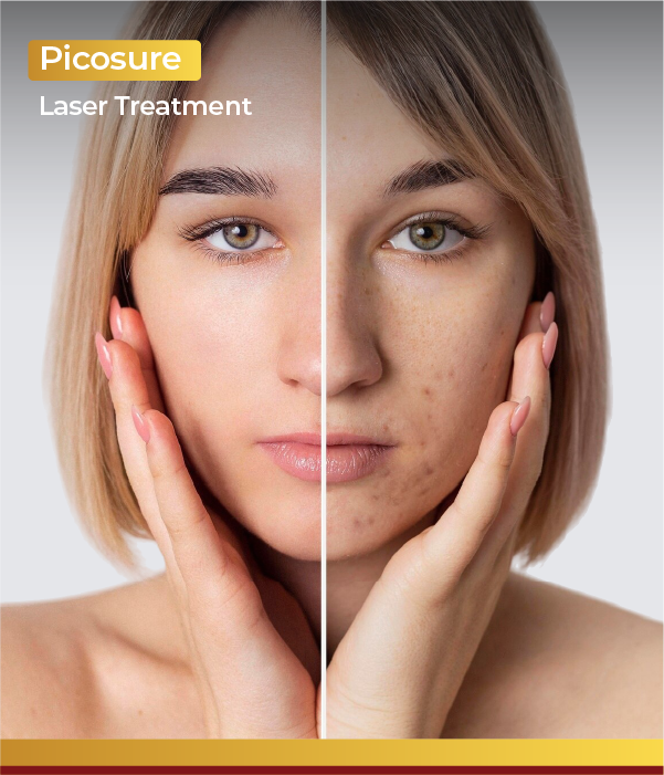 Picosure Laser Treatment